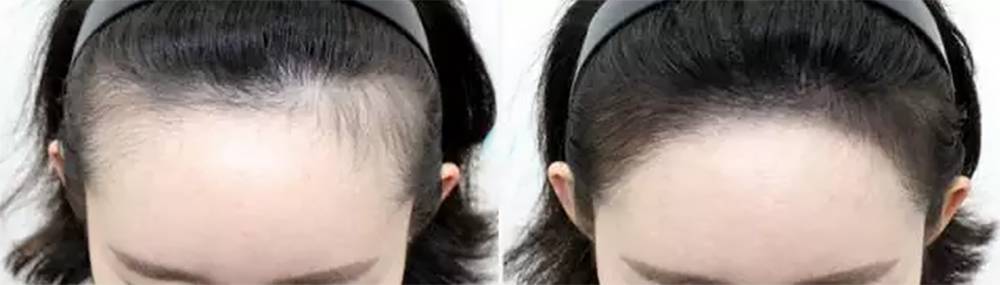 韩国纹发际线对比图
