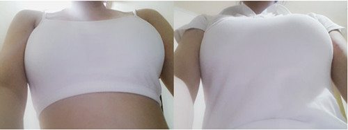 韩国水滴形假体隆胸术后第三周
