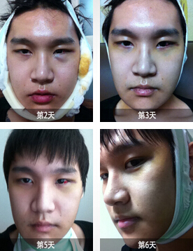 韩国面部轮廓手术后2-6天