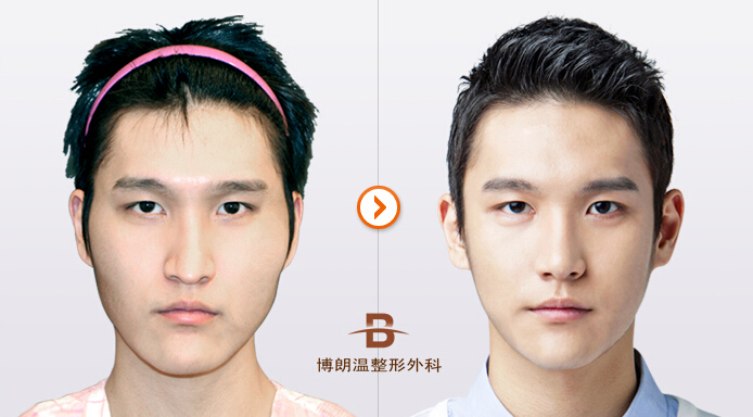 韩国面部轮廓手术对比