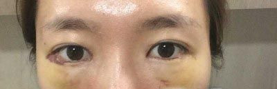 韩国眼底脂肪重置恢复周