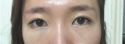 韩国眼底脂肪重置术后恢复第二周