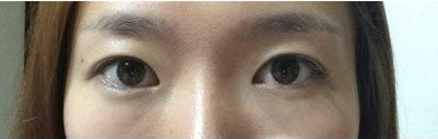 韩国眼底脂肪重置整形日记术后恢复第二个月