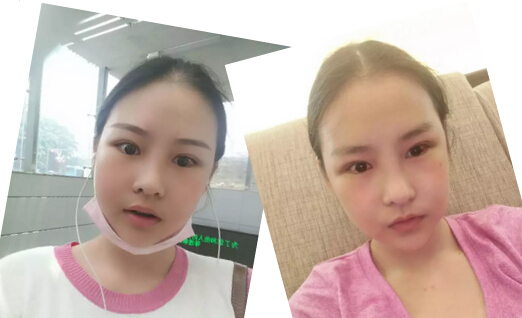 在韩国DA整形修复手术后2周的样子