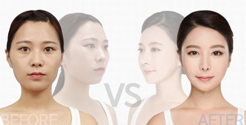 韩国面部轮廓整形对比案例