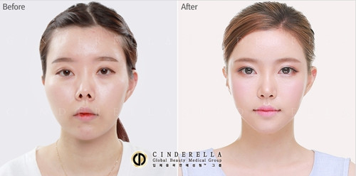 韩国灰姑娘鼻部修复手术案例