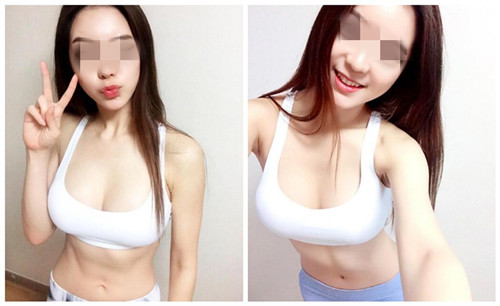 韩国女神假体隆胸术后恢复第六个月