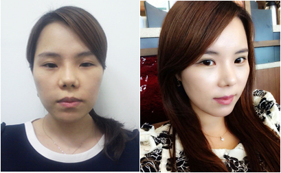 韩国鼻综合手术对比图