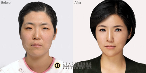 韩国灰姑娘上睑下垂矫正手术对比案例