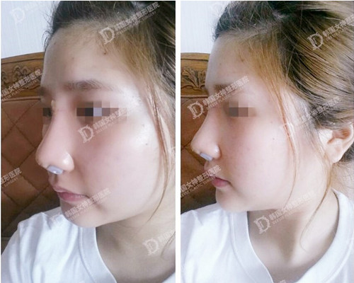 韩国女神隆鼻手术真人秀术后周