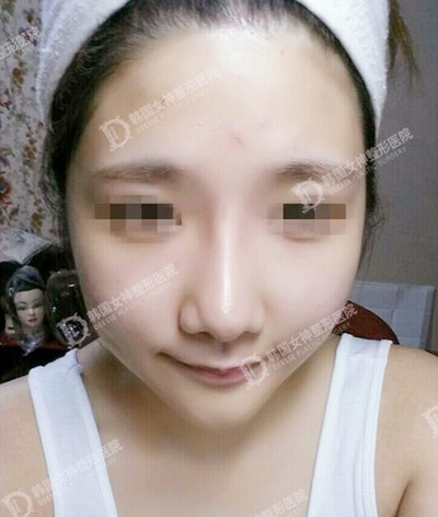 韩国女神鼻子整形真人秀术后个月