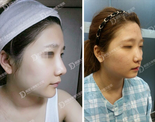 韩国女神整形医院vline术后个月恢复