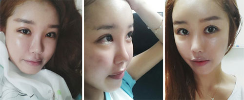 韩国id医院做眼鼻整形案例术后两周照片