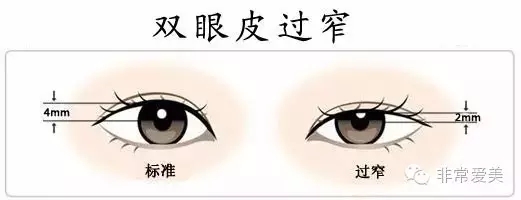 韩国新帝瑞娜郑钟必的电眼整形和眼综合有什么区别？