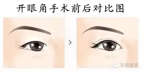 韩国新帝瑞娜郑钟必的电眼整形和眼综合有什么区别？