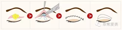 进行双眼皮手术时，去除上睑脂肪卡通示意图