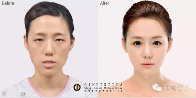 韩国新帝瑞娜整形医院，电眼整形手术对比图