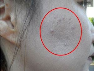 韩国清潭珠颜皮肤整形医院激光祛痘仅需1800，优惠大起底