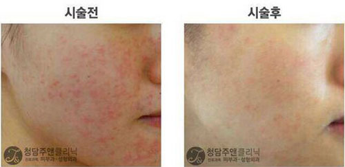 韩国清潭珠颜皮肤整形医院激光祛痘仅需1800，优惠大起底