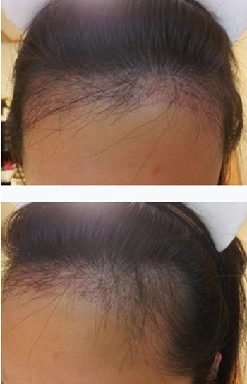 韩国巴诺巴奇毛发移植术后第二个月