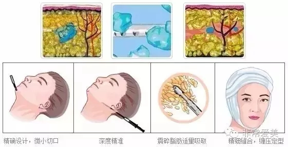 面部吸脂和瘦脸针哪个瘦脸效果好？