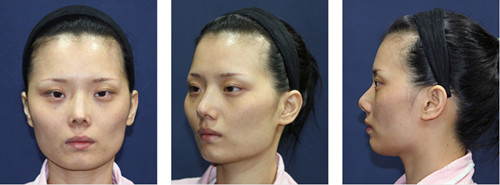 韩国博朗温整形外科面部轮廓真人秀