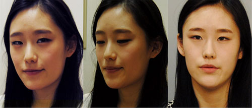 在韩国id整形做双颚和双眼皮手术前