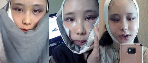在韩国id整形做双颚和双眼皮手术当天