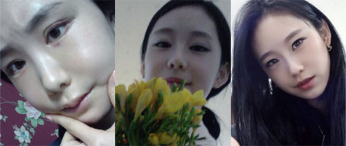 在韩国id整形做双颚和双眼皮手术术后一个月
