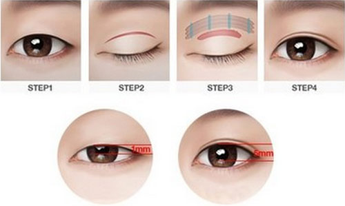 韩国做双眼皮手术需要准备多少钱？