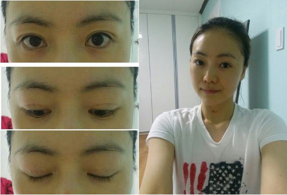 韩国双眼皮+提肌调整整形真人秀术后第二周