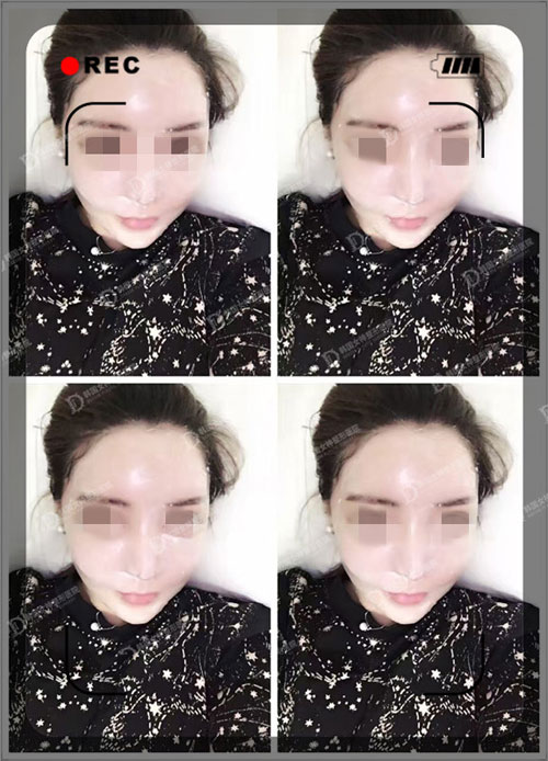 在韩国女神整形做完面部轮廓手术后一个月