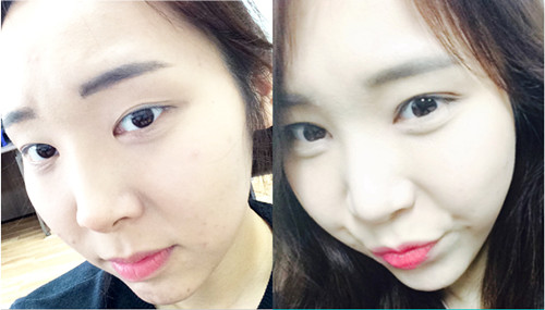韩国江南三星双眼皮整形真人秀手术前后对比照片