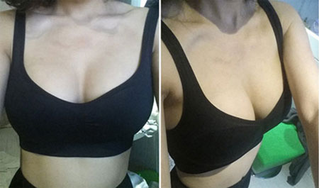 韩国id整形做完假体隆胸术后一个月