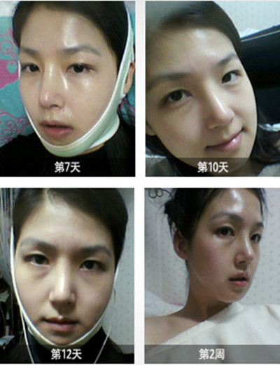 韩国眼部整形术前术后对比案例