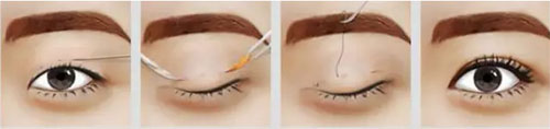 定位法双眼皮手术过程示意图