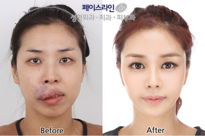 韩国face-line整形医院李真秀的脸型案例