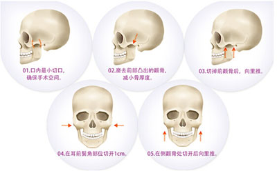 脸部骨骼大  应该用什么方法来瘦脸？