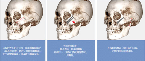 狎鸥亭哪家整形医院做颧骨技术受欢迎？