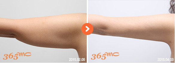 韩国365MC手臂吸脂对比