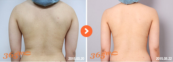 韩国365MC后背吸脂对比