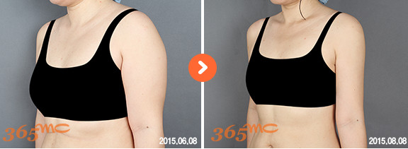 韩国365MC后背吸脂对比