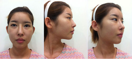 韩国绮林整形外科做手术前的照片