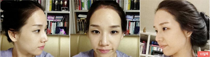 韩国多娜发际线植发真人秀术后第十天