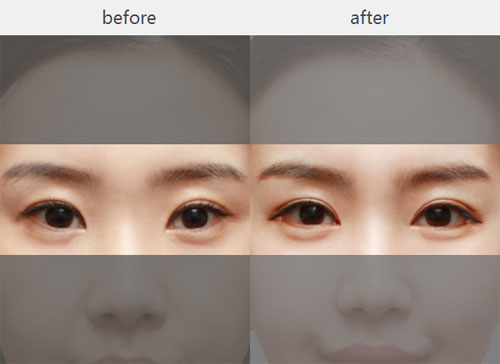 双眼皮线条不对称修复术前术后对比