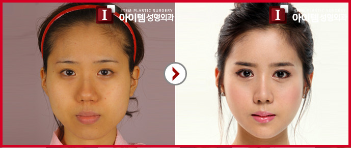 面部轮廓对比案例 韩国爱婷整形外科