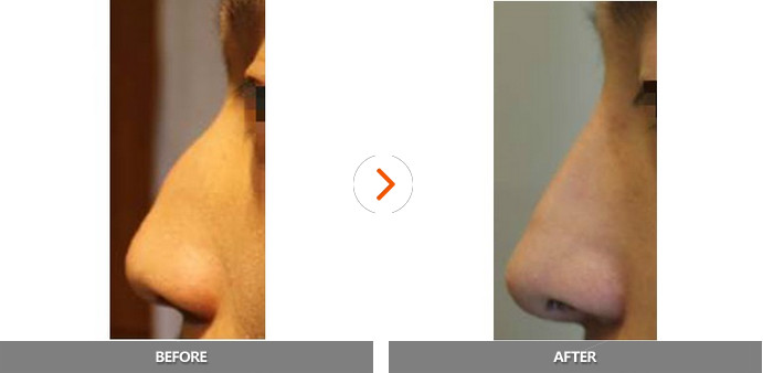 鼻部整形对比案例 韩国明星线整形外科