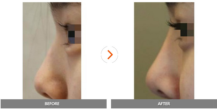 鼻部整形对比案例 韩国明星线整形外科