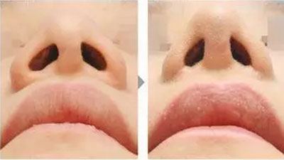 蒜头鼻整形术前术后对比图