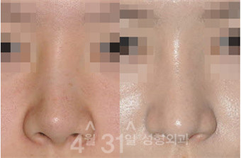 鼻修复对比案例 韩国4月31日整形医院